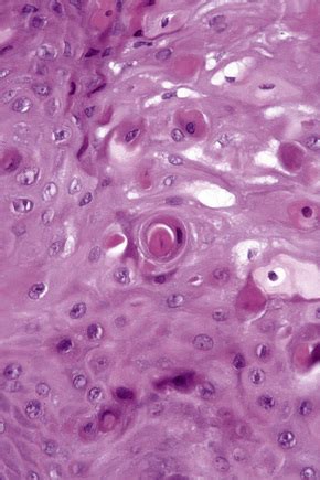 The edges of the tongue, is characterized by poorly demarcated white raised lesions with a corrugated appearance. Diseases of the oral mucosa | Basicmedical Key