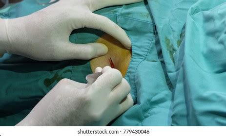 Even though it's crude, it should give a fair idea of the steps we must follow during the procedure. Chest Tube Stock Images, Royalty-Free Images & Vectors ...