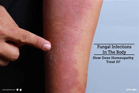 Fungal Infections In The Body How Does Homeopathy Treat It By Dr Arun Bhatia Lybrate