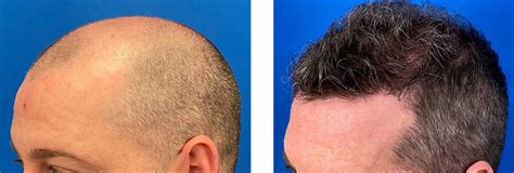 Norwood Class 5 Hair Transplant In 1 Session Hair Transplant Case