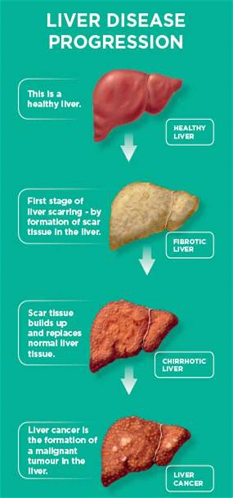 This test produces very clear images of the human body liver cancer that is not treated successful is fatal, but researchers are working daily to find more effective treatments. Primary Liver Cancer Symptoms, Diagnosis and Treatment