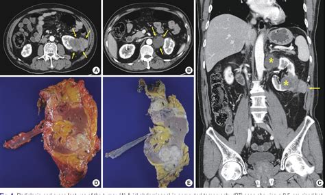 Figure 1 From Malignant Rhabdoid Tumor Of The Kidney In An Adult With
