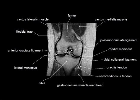 Knee Anatomy Mri Knee Coronal Anatomy Free Cross Sectional Anatomy