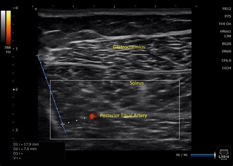 Posterior Tibial Tendon Ultrasound