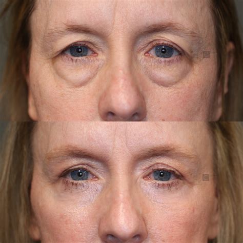 Eye Bag Removal Spokane | Eye Bag Enigma Lift Spokane