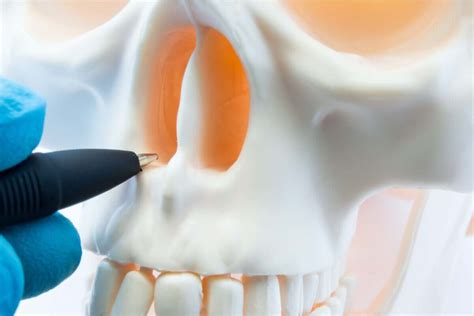 A deviated septum is when this wall is shifted away from the midline. Nasal Septum Perforation: Causes, Symptoms, and Treatment
