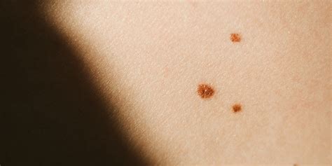 What Do Red Spots On Skin Mean 13 Skin Spots Bumps Pictures Ph