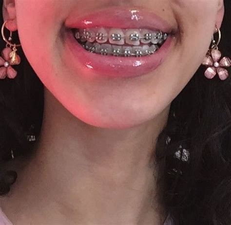 Pin By Surovtsevva On My Aesthetic Cute Braces Braces Girls Cute Braces Colors