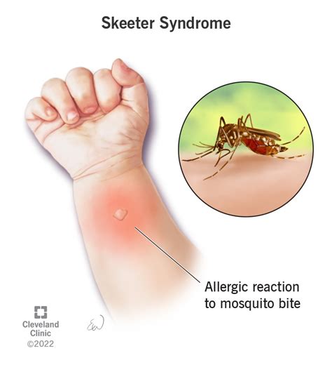 Terrifying Mosquito Bite Symptoms You Cant Ignore Learn Quick Treatment Tips Now CURIOUS