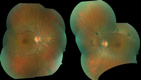 Pigmented Paravenous Retinochoroidal Atrophy Associated With Unilateral
