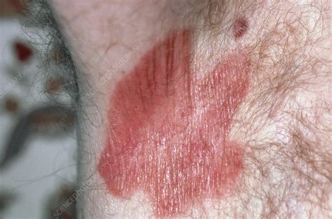 Erythrasma Skin Infection In Mans Armpit Stock Image M1500133