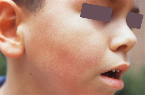 What To Know About Fifth Disease Keep Kids Healthy