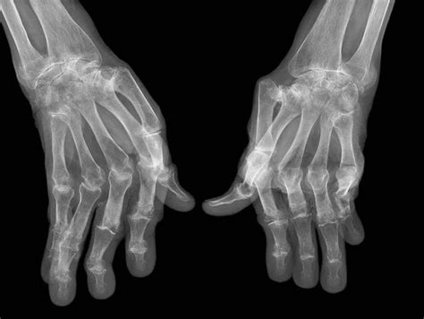 Rheumatoid arthritis (ra) is a chronic systemic inflammatory disease of unknown cause. In Rheumatoid Arthritis, Combination Therapy More ...