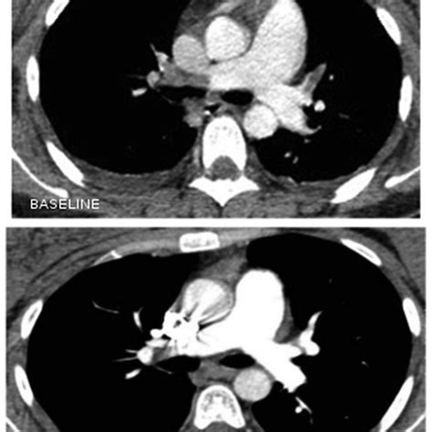 Ct Pulmonary Angiography Of Case 1 Patient At Baseline And 10 Days