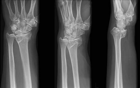 Barton Fracture