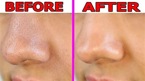 Large Pores Treatment In Dubai Laser Skin Care Clinic Dubai