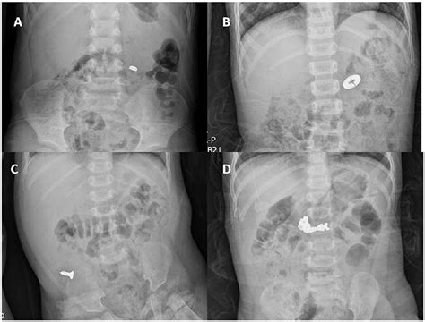 Frontiers Analysis Of Radiopaque Gastrointestinal Foreign Bodies
