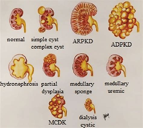 Schemmatic Representation Of Frequent Renal Cysts Or Cystic Diseases