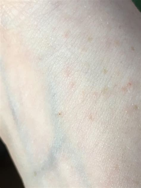 There Are A Number Of Tiny White Bumps On Both My Wrists Dermatology