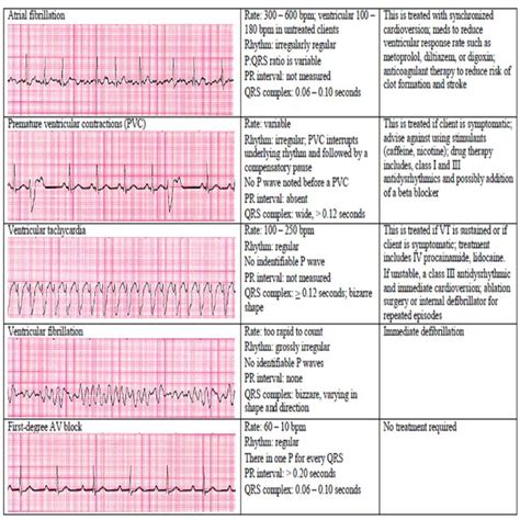 Cardiac Rhythm And Dysrhythmias Cheat Sheet Any Nurse Must Know For