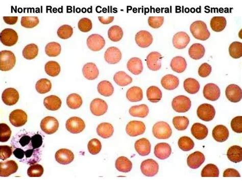 Ppt Normal Red Blood Cells Peripheral Blood Smear Powerpoint