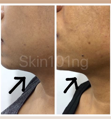 Double Chin Removal Injection Lipolysis Skin101 Center