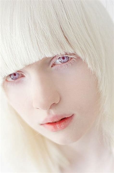 Pin By Guillermo Lozano On Albino Albino Model Albinism Albino Girl