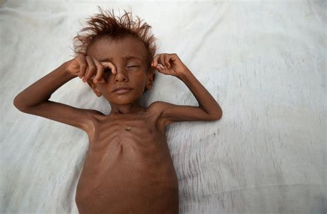 Famine Threatens Yemen Amid Civil War Photos Image 71 ABC News