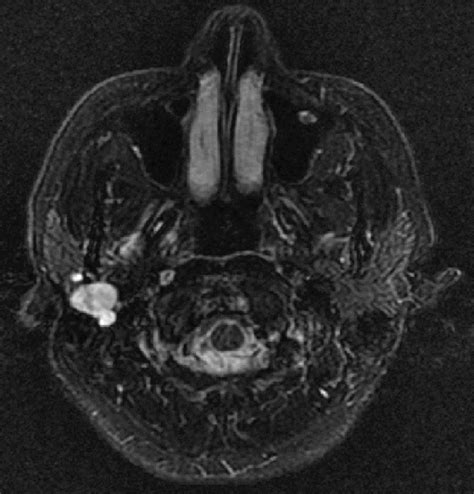Figure5contrast Enhanced Mri T2wi Showed A 17 Mm Tumor In The Right