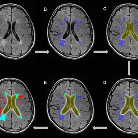Pdf Periventricular Lesions Correlate With Cortical Thinning In