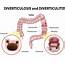 Diverticulitis Causes Symptoms And Treatments