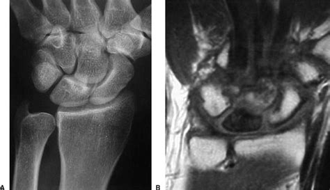 Kienbocks Disease Hand Orthobullets