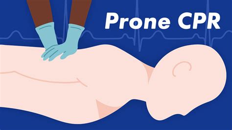 How To Perform Cpr On Prone Position Patients Ausmed