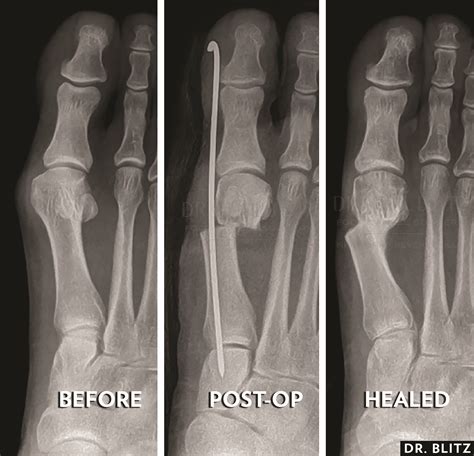 Current Concepts In Minimally Invasive Bunion Surgery