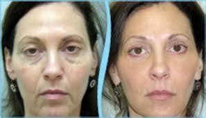 Subcutaneous injections are highly effective in administering medications such as insulin, morphine, diacetylmorphine and goserelin. PRP Facial Rejuvenation - Part 1 | Wembly Clinic