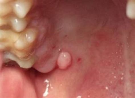 bump or lump on the roof of mouth causes treatment home remedies