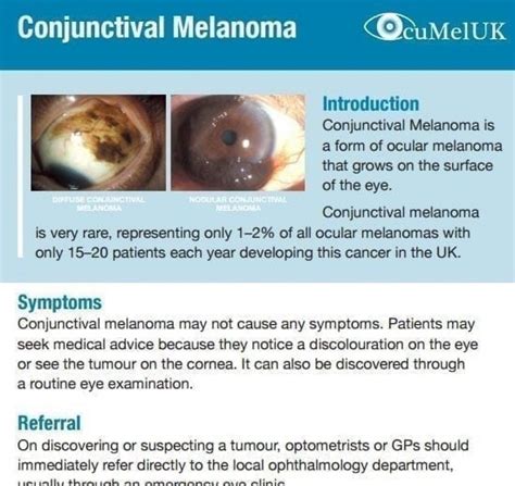 Conjunctival Melanoma Information For Your Gp Ocumel Uk