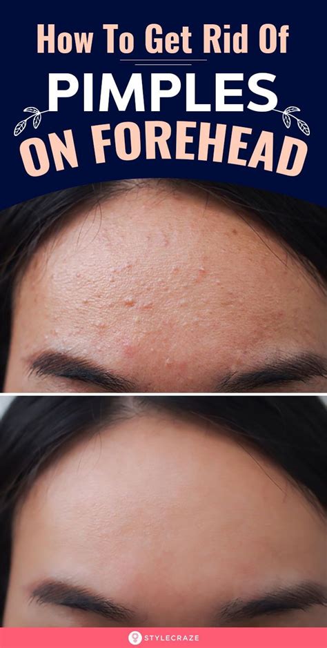 Forehead Acne Causes Treatment And Prevention Pimples On Forehead