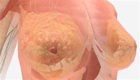 Breast Cancer In Lymph Nodes Prognosis