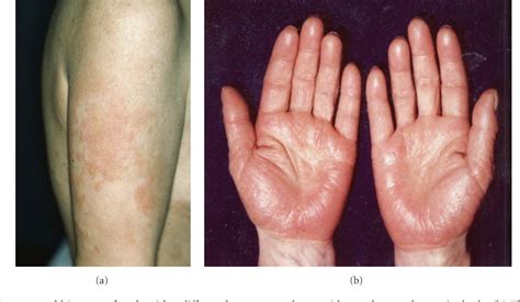 Pdf Metal Allergy And Systemic Contact Dermatitis An Overview