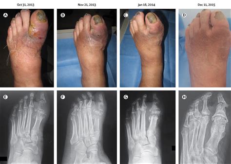 Non Surgical Treatment Of Diabetic Foot Osteomyelitis The Lancet