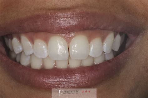 Cosmetic Composite Bonding vs Veneers | Spath Dentistry