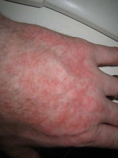 Pics For Rashes On Hands