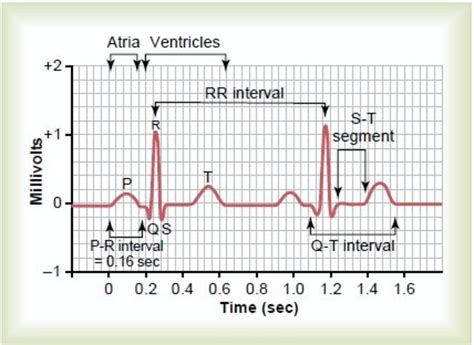 What Does A Normal Ecg Look Like A Normal Ekg Is One That Shows What