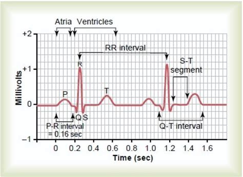 An electrocardiogram, or ecg, is a graphical recording of the electrical events occurring within the a cardiologist can look at a patient's electrocardiogram and determine the presence of damaged assessment of the condition of the heart were done with the use of electrocardiogram graph. How to read a normal ECG(Electrocardiogram)? | HubPages