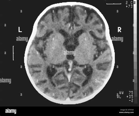 Ct Scan Showing Hiv Encephalopathy Stock Photo Alamy