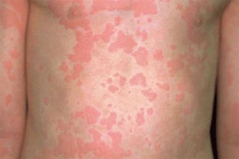 Conjuntivite Alérgica Ás Clínica De Alergia