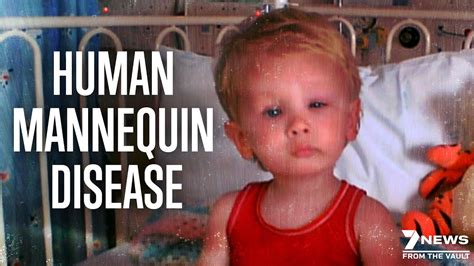 World S Rarest Disease The Human Mannequin Documentary Youtube