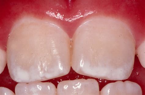 Dental Fluorosis Causes Prevention Symptoms And Dental Fluorosis Treatment