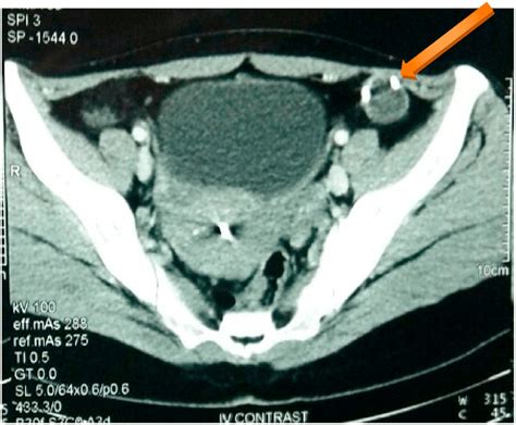 Abdomino Pelvic Contrast Enhanced Computed Tomography Showing A Cystic